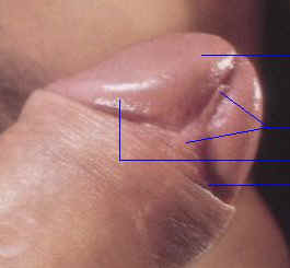 Frenulum.jpg (11 KB)