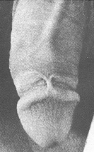 Circumcision Damage - Skin Bridge1 (33 KB)
