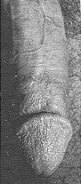 Circumcision Damage - Keratinization (24 KB)