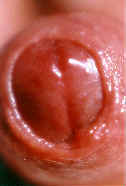 Moist Glans.jpg (3 KB)