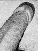 Circumcision Damage - Missing Frenulum (36 KB)