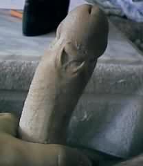 Circumcision Damage - Skin Bridge2 (5 KB)